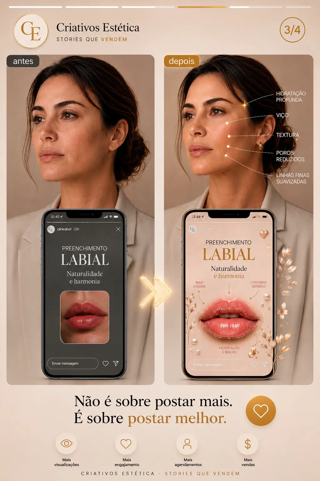Antes e depois de Story de Preenchimento em detalhe usando o Criativos Estética